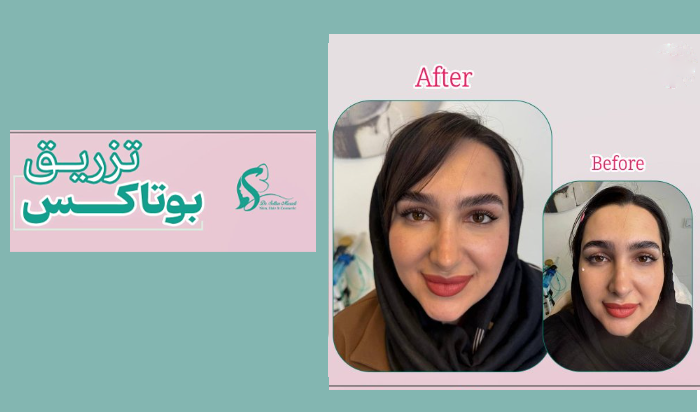 تزریق بوتاکس الناز سلطان مرادی در زنجان