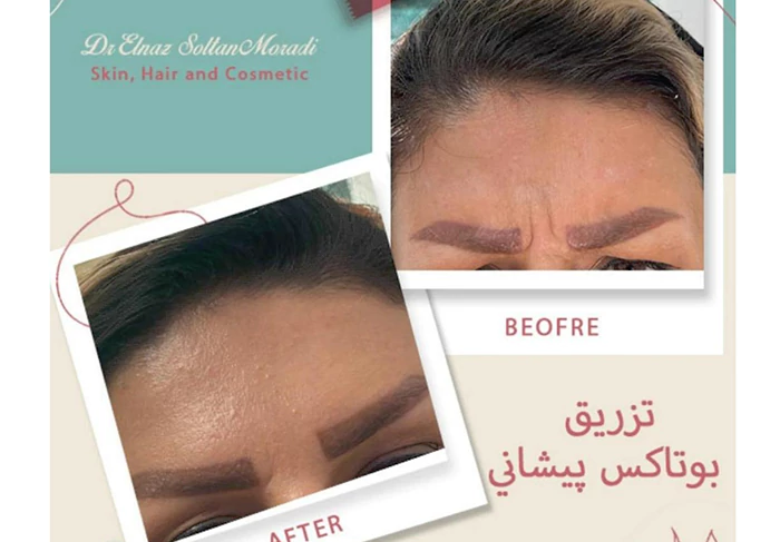 تزریق بوتاکس پیشانی
