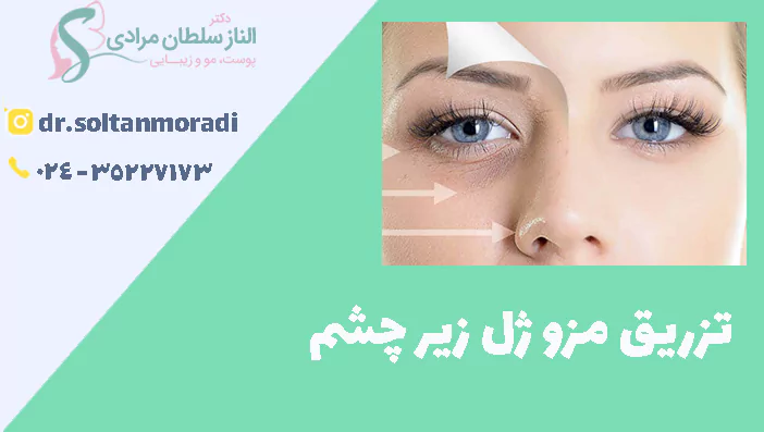 تزریق مزو ژل زیر چشم