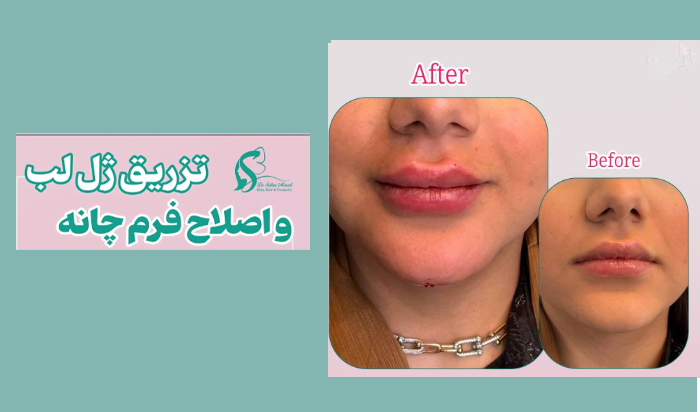 تزریق ژل لب نمونه کار دکتر الناز سلطان مرادی
