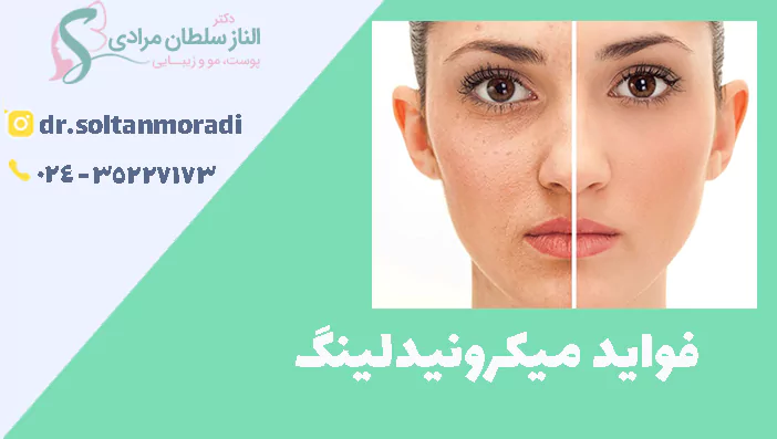 فواید میکرونیدلینگ