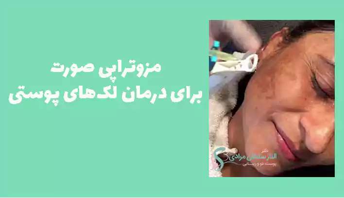 مزوتراپی صورت برای درمان لک‌های پوستی