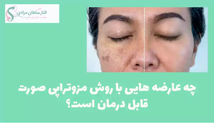چه عارضه هایی با روش مزوتراپی صورت قابل درمان است؟