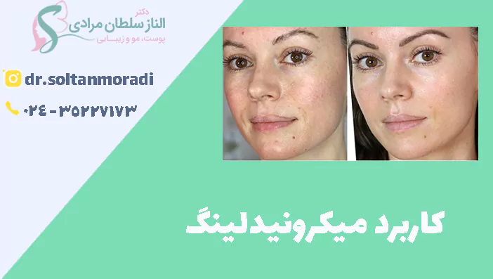 کاربرد میکرونیدلینگ