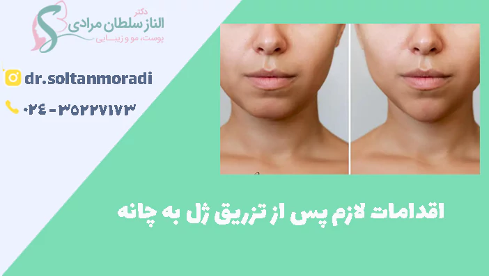 اقدامات لازم پس از تزریق ژل به چانه