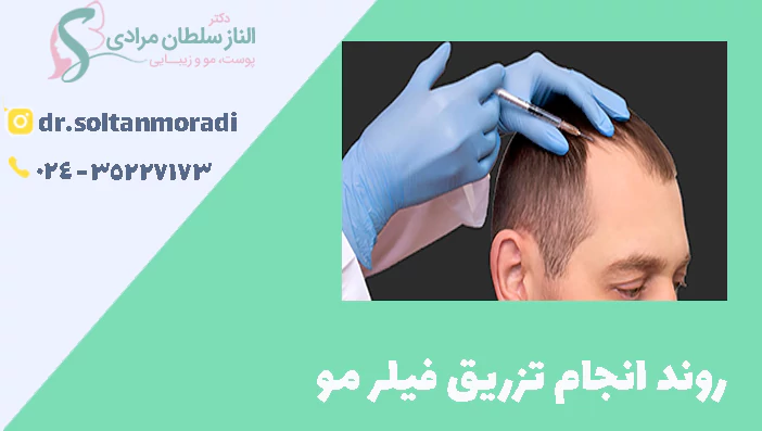 روند انجام تزریق فیلر مو