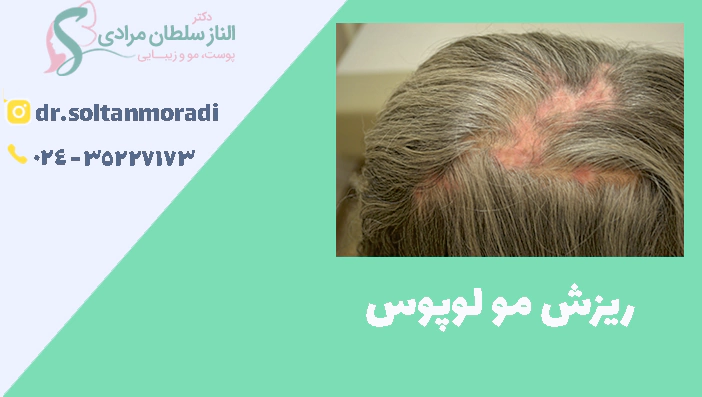 ریزش مو لوپوس