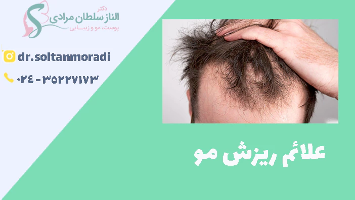 علائم ریزش مو