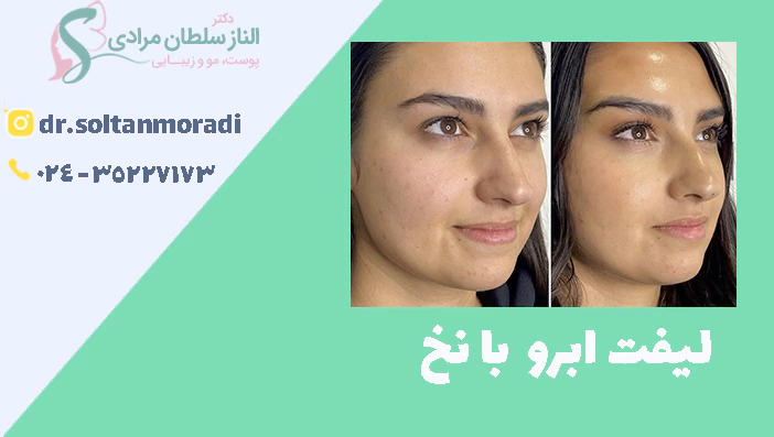 لیفت ابرو با نخ