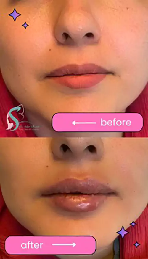 تزریق ژل لب در زنجان عکس