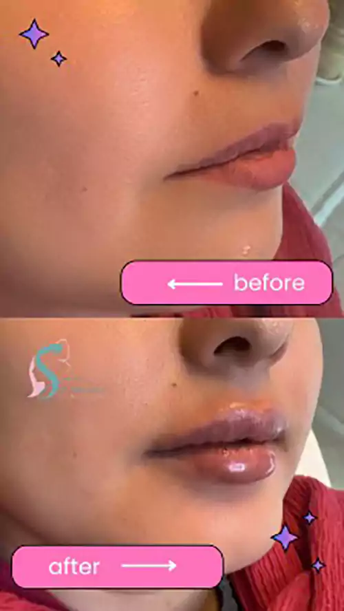 نمونه کار تزریق ژل لب در زنجان