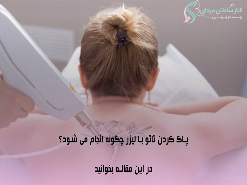 پاک کردن تاتو با لیزر