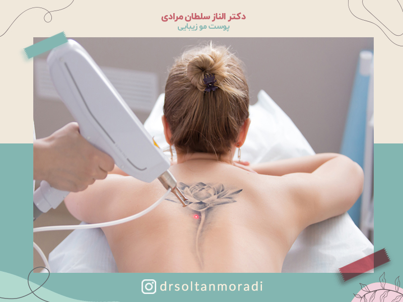 پاک-کردن-تتو-با-لیزر