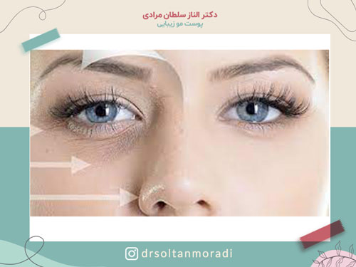 درمان گودی زیر چشم با تزریق فیلر