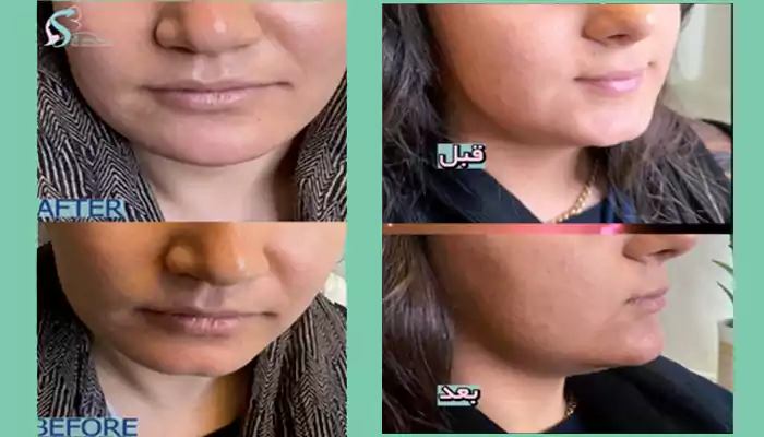 اصلاح فرم چانه با تزریق فیلر